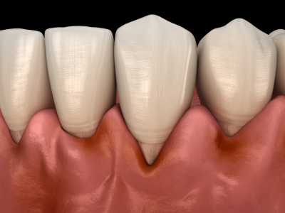 Gingivitis