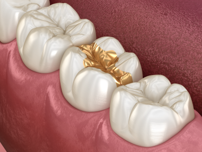 Inlay Gold