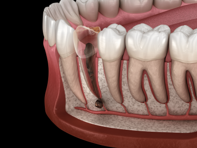 Periostitis-Zahn