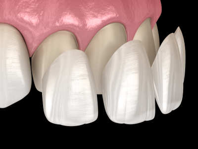 Verblendung mit Veneers