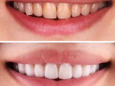 Vorher - Nachher - Veneers